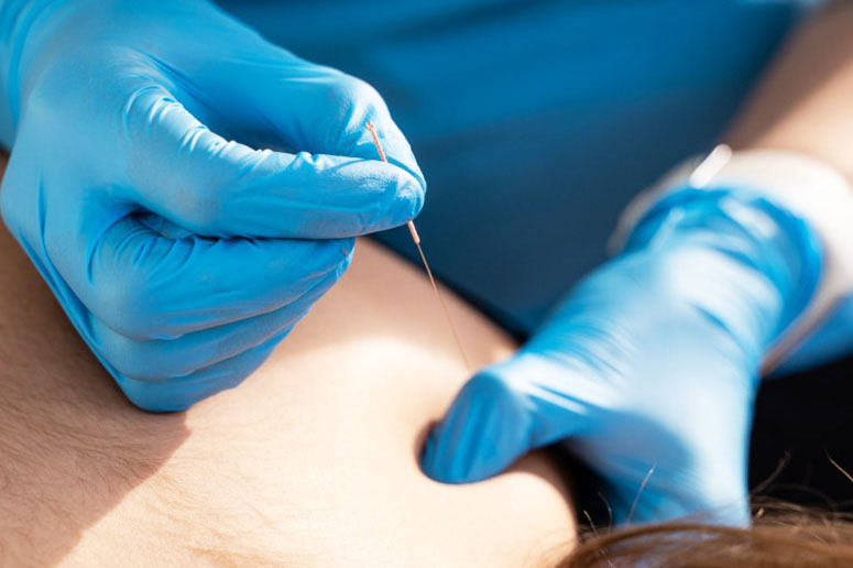 dry-needling